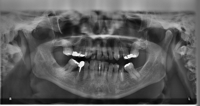 x-ray shows mercury in dental fillings